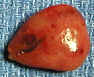 parathyroid gland adenoma photo