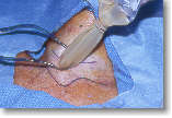 Placing the radioguided probe in the small wound to find the parathyroid tumor.
