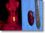 Radioactive parathyroid tumor shows up on this sestamibi scan.