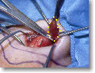 Removing the parathyroid tumor.