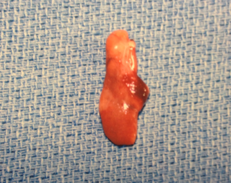 Failed Parathyroid Surgery: Yesterday's Three Unsuccessful Parathyroid ...