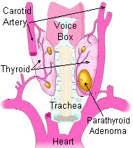 parathyroid adenoma